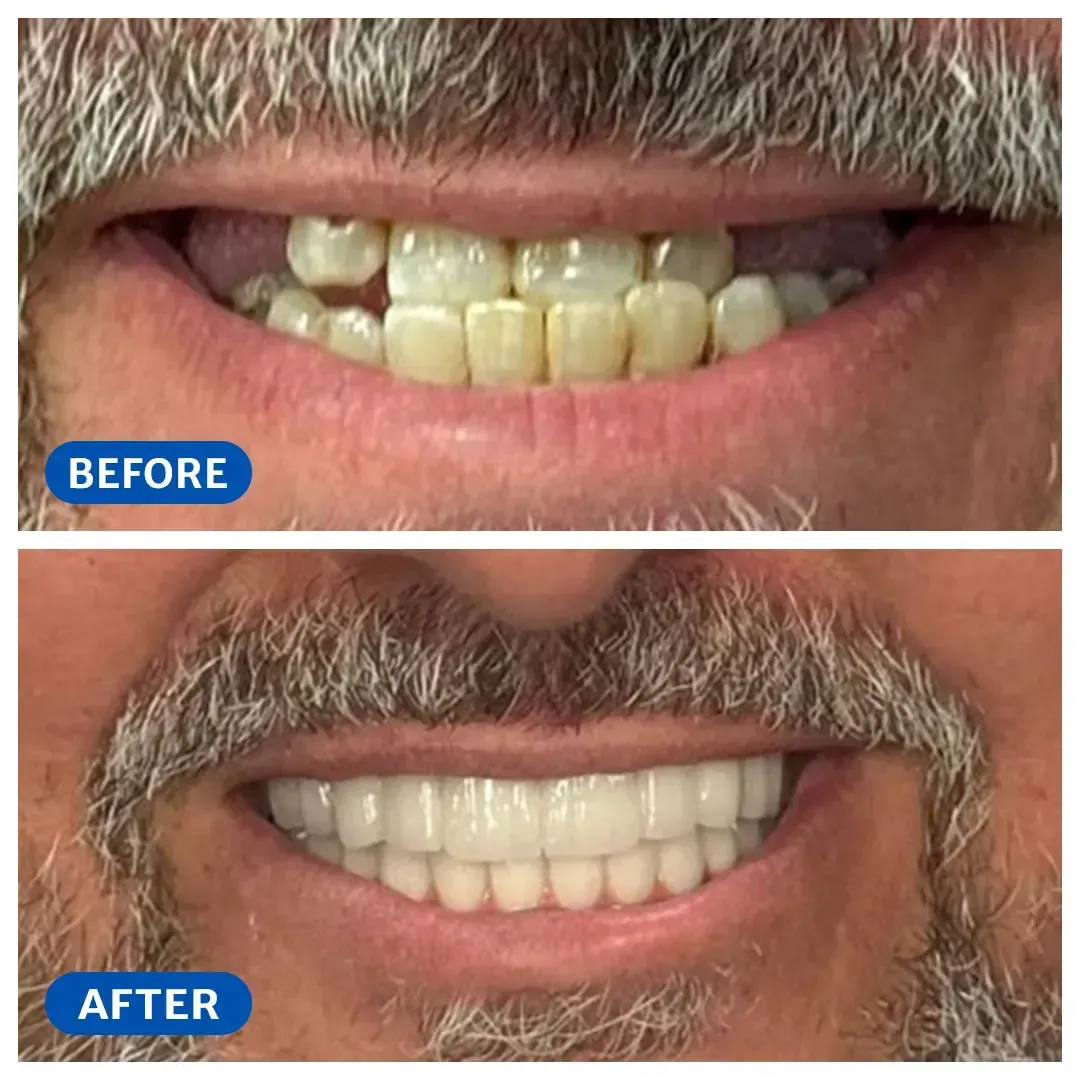 Smile transformation 3