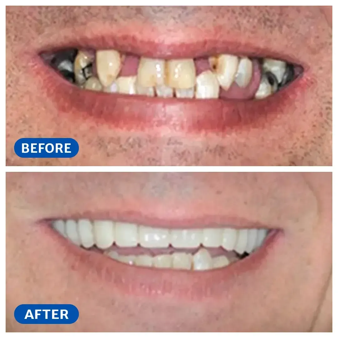 Smile transformation 4