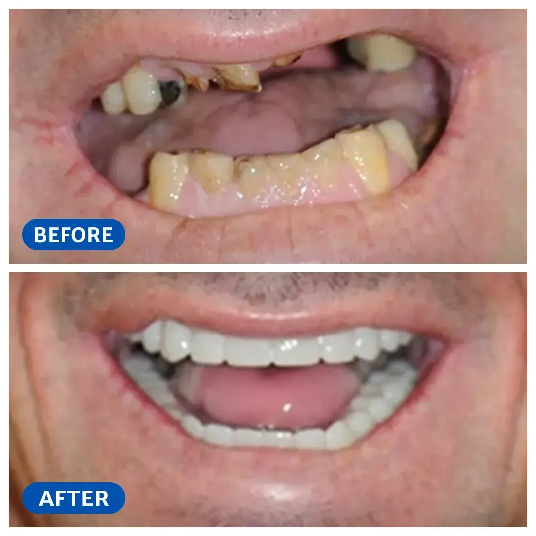 Smile transformation 5